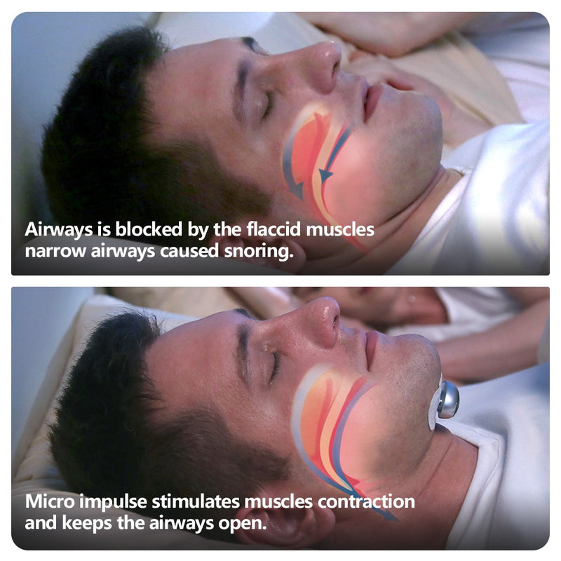 Advanced Smart Anti-Snoring Device - Electronic Sleep Aid with Muscle Stimulator & 20 Conductive Strips