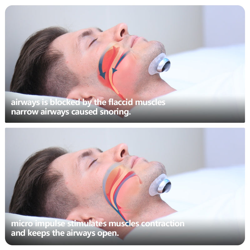Advanced Anti-Snoring Sleep Solution - Smart Electronic Muscle Stimulator with 20 Conductive Strips